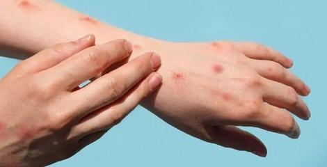 تکذیب ورود بیمار مبتلا به “آبله میمونی” به ایران