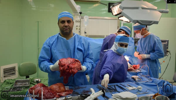 خارج کردن توده ۲۰ کیلویی از شکم یک مرد ۶۵ ساله در تبریز
