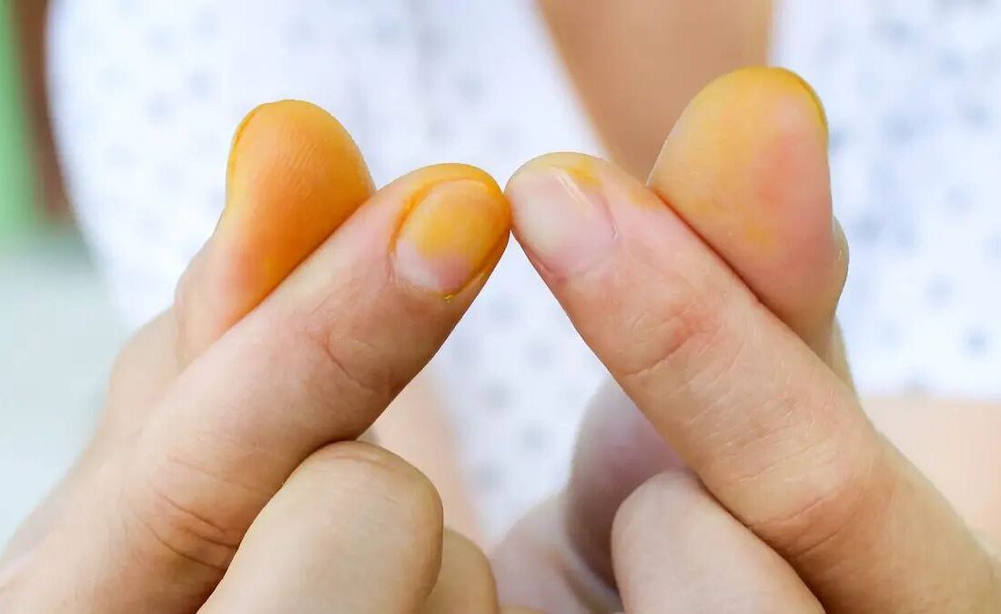 روش‌‌های ساده برای پاک کردن لکه زردچوبه از ناخن و دست